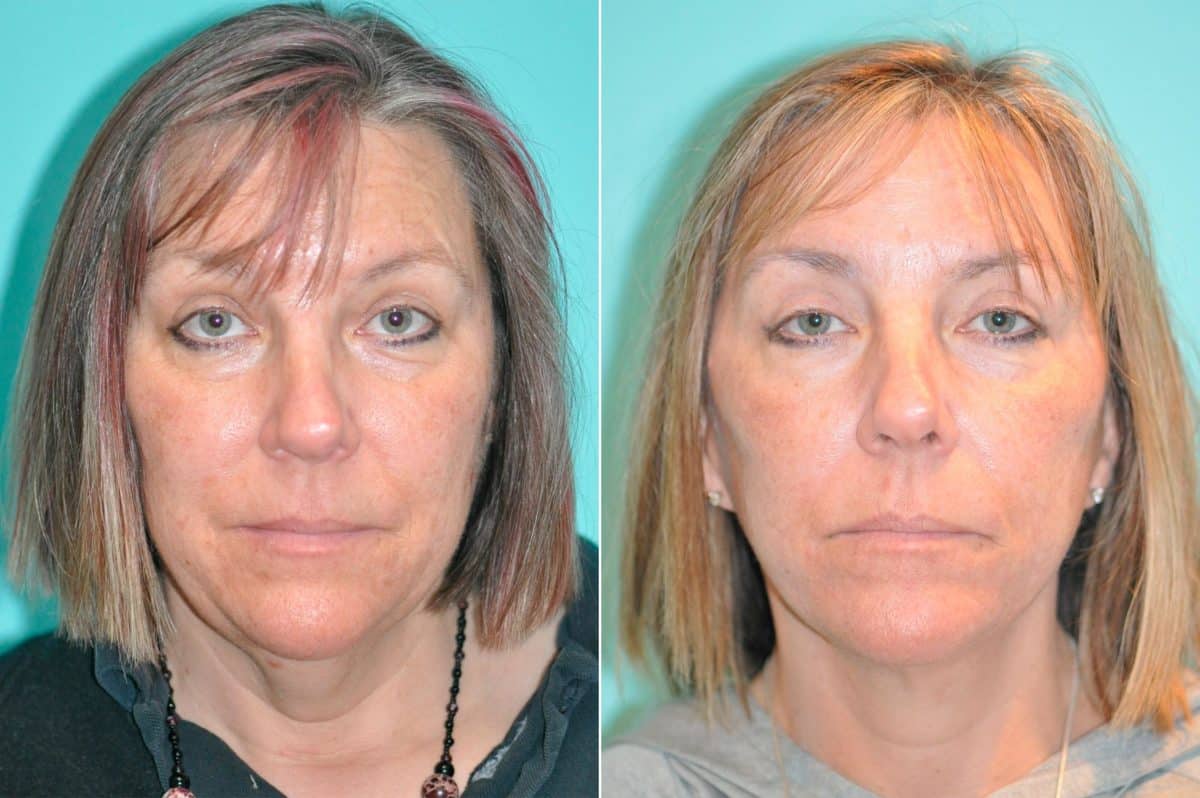 Before and after Facelift by Dr. Shervin Naderi, Patient 14649