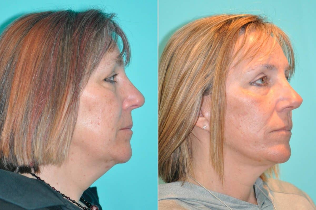 Before and after Facelift by Dr. Shervin Naderi, Patient 14649