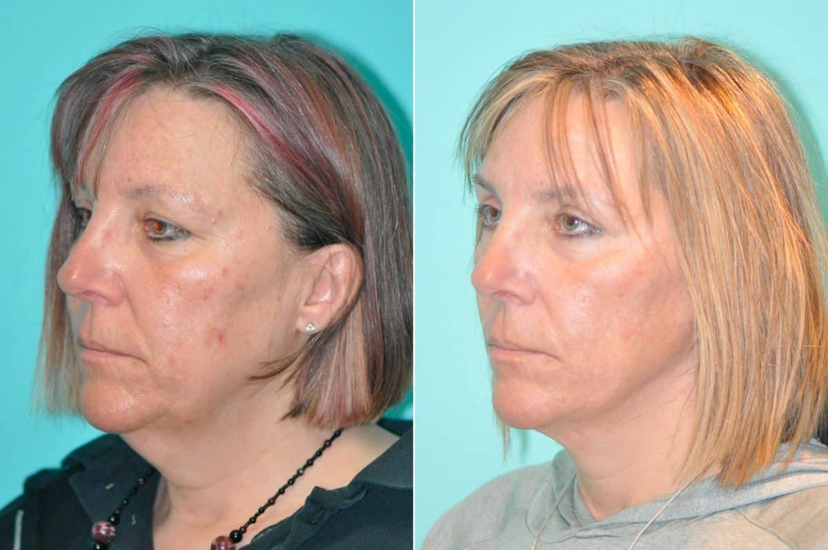 Before and after Facelift by Dr. Shervin Naderi, Patient 14649