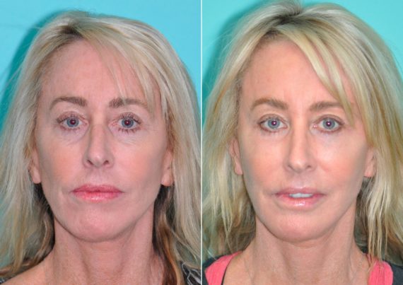Fat Transfer before and after photos in Chevy Chase, MDFat Transfer Before and After Photos in Chevy Chase, MD