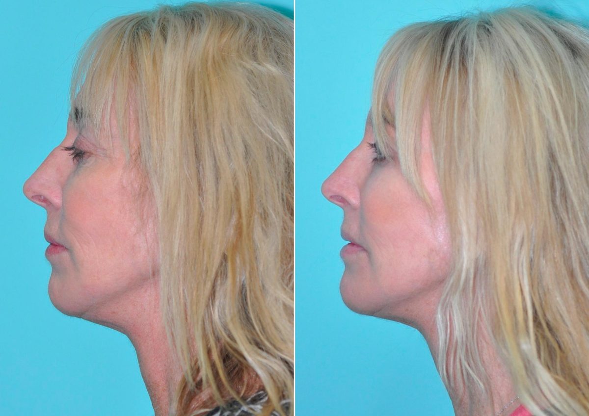 Before and after Laser Treatments by Dr. Shervin Naderi, Patient 14614