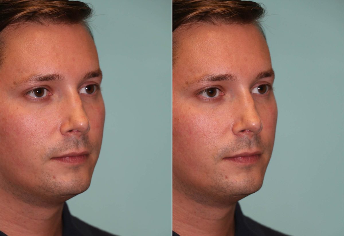 Before and after Non-Surgical Rhinoplasty by Dr. Shervin Naderi, Patient 12047