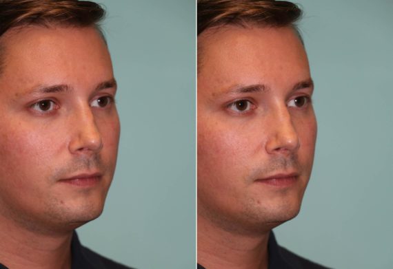 Before and after Non-Surgical Rhinoplasty by Dr. Shervin Naderi, Patient 12047