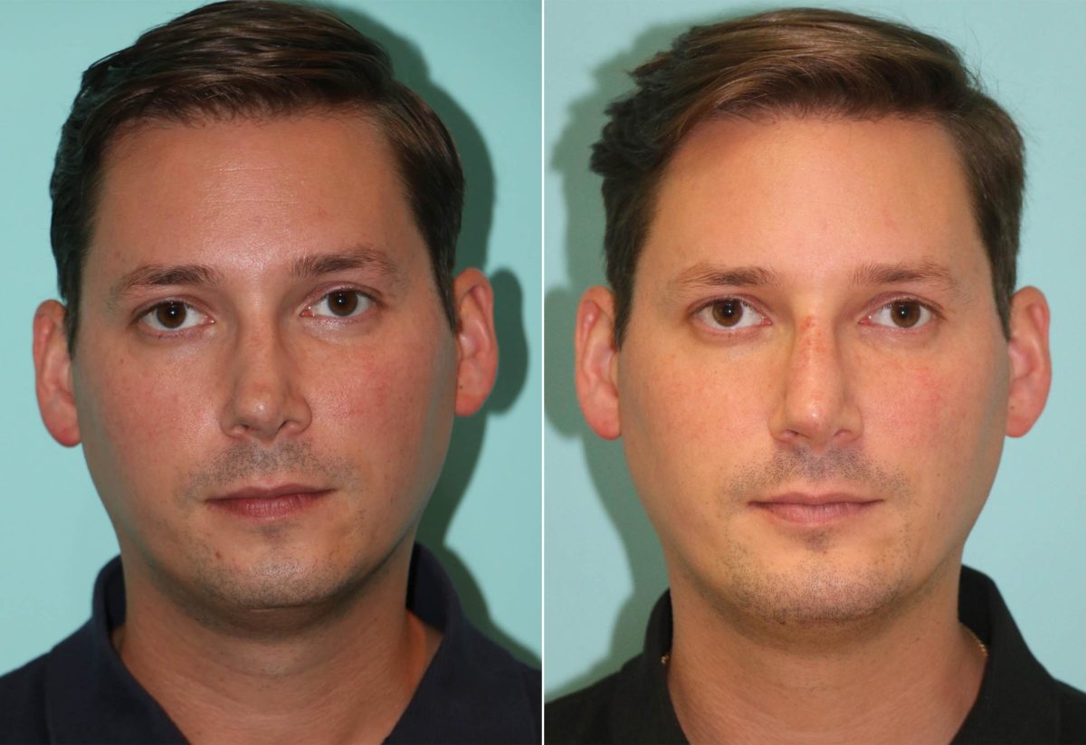 Before and after Non-Surgical Rhinoplasty by Dr. Shervin Naderi, Patient 12047