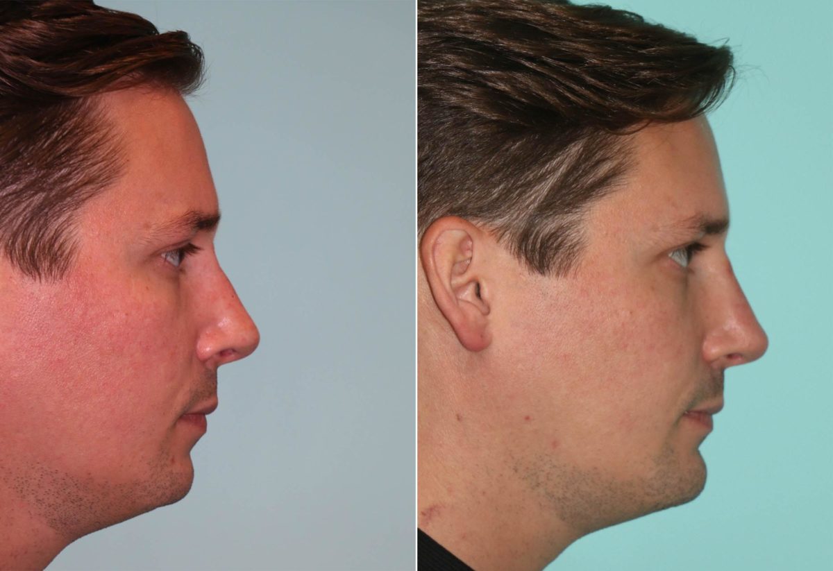 Before and after Non-Surgical Rhinoplasty by Dr. Shervin Naderi, Patient 12047