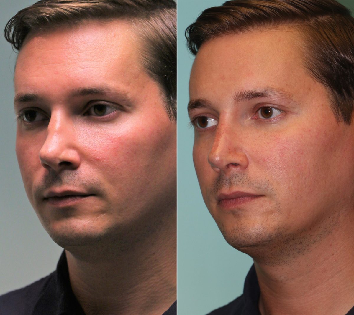 Before and after Non-Surgical Rhinoplasty by Dr. Shervin Naderi, Patient 12047