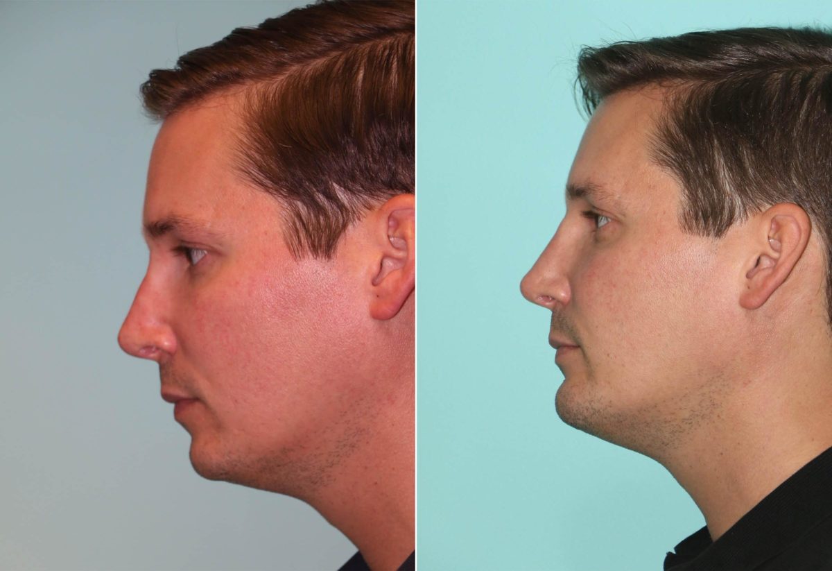 Before and after Non-Surgical Rhinoplasty by Dr. Shervin Naderi, Patient 12047