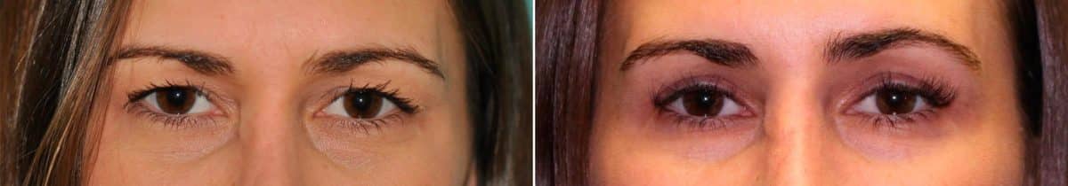 Before and after Blepharoplasty by Dr. Shervin Naderi, Patient 14438