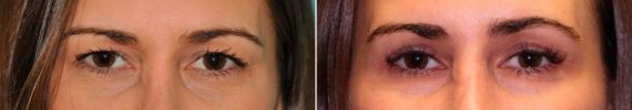 Before and after Blepharoplasty by Dr. Shervin Naderi, Patient 14438