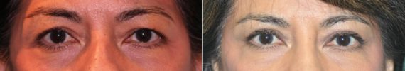 Before and after Blepharoplasty by Dr. Shervin Naderi, Patient 14448