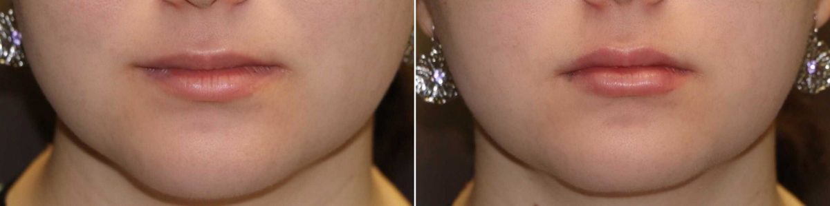 Before and after Lip Augmentation by Dr. Shervin Naderi, Patient 14455