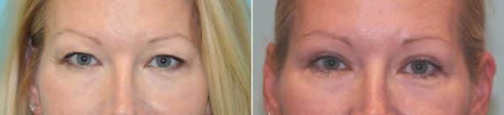 Before and after Blepharoplasty by Dr. Shervin Naderi, Patient 14484