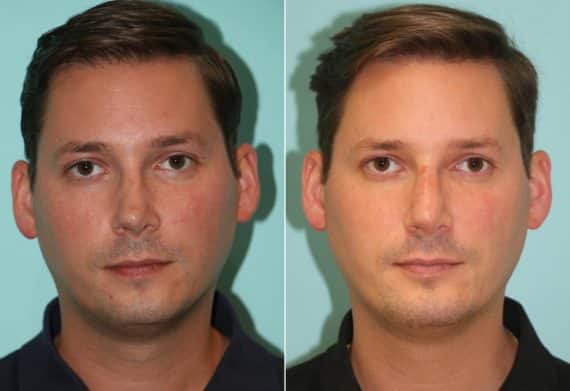 Before and after Chin & Facial Implant by Dr. Shervin Naderi, Patient 14491