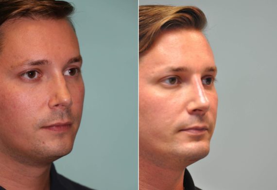 Before and after Chin & Facial Implant by Dr. Shervin Naderi, Patient 14491