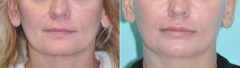 Before and after Lip Implant by Dr. Shervin Naderi, Patient 14510