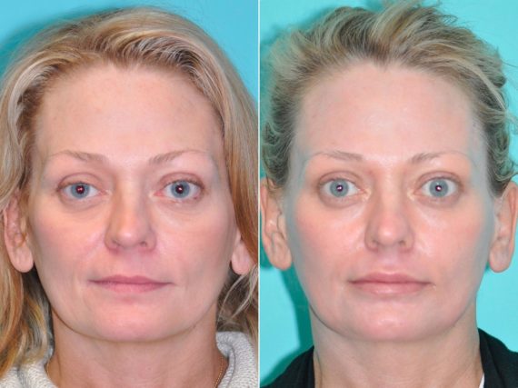 Before and after Laser Treatments by Dr. Shervin Naderi, Patient 14527