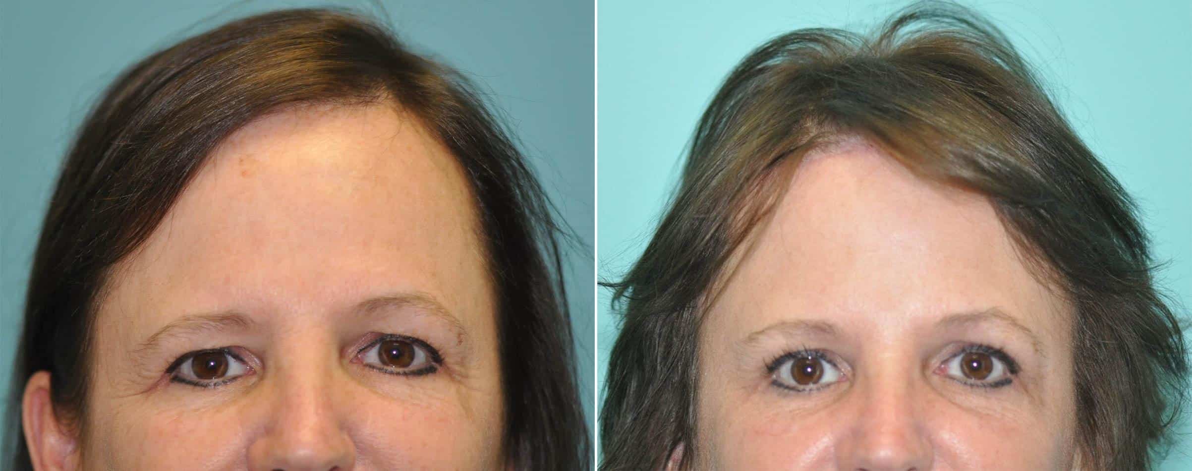 Brow Lift Virginia Forehead Lift browlift Washington D.C. and Maryland