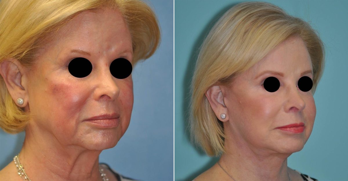 Before and after Facelift by Dr. Shervin Naderi, Patient 14541