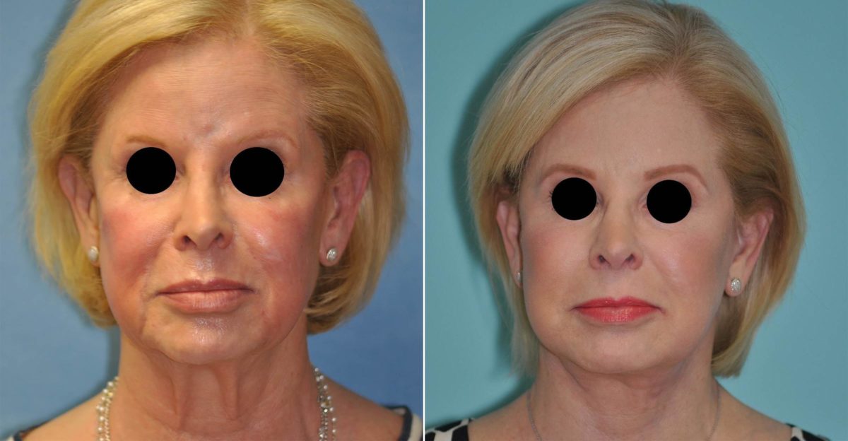 Before and after Facelift by Dr. Shervin Naderi, Patient 14541