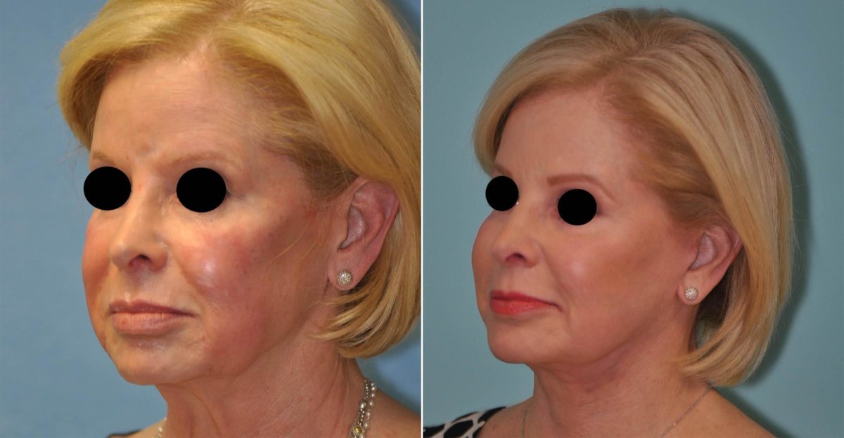 Before and after Facelift by Dr. Shervin Naderi, Patient 14541