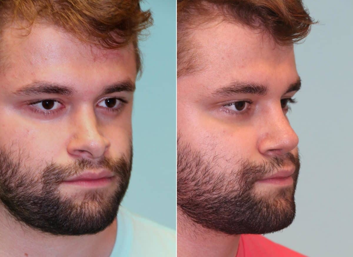 Before and after Revision Rhinoplasty by Dr. Shervin Naderi, Patient 14725