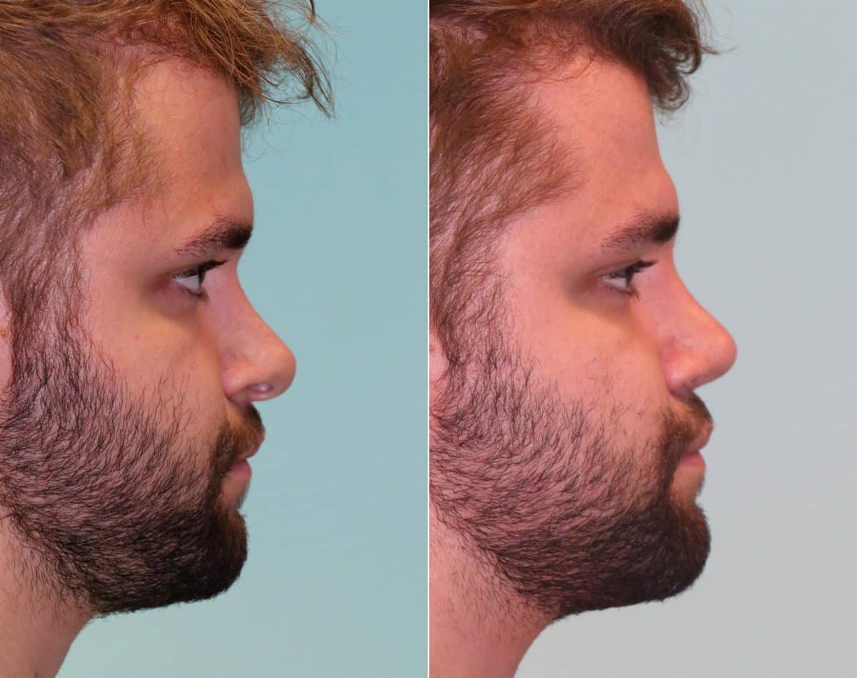 Patient 14725, Revision Rhinoplasty Before and After Photos Before and after Revision Rhinoplasty by Dr. Shervin Naderi, Patient 14725