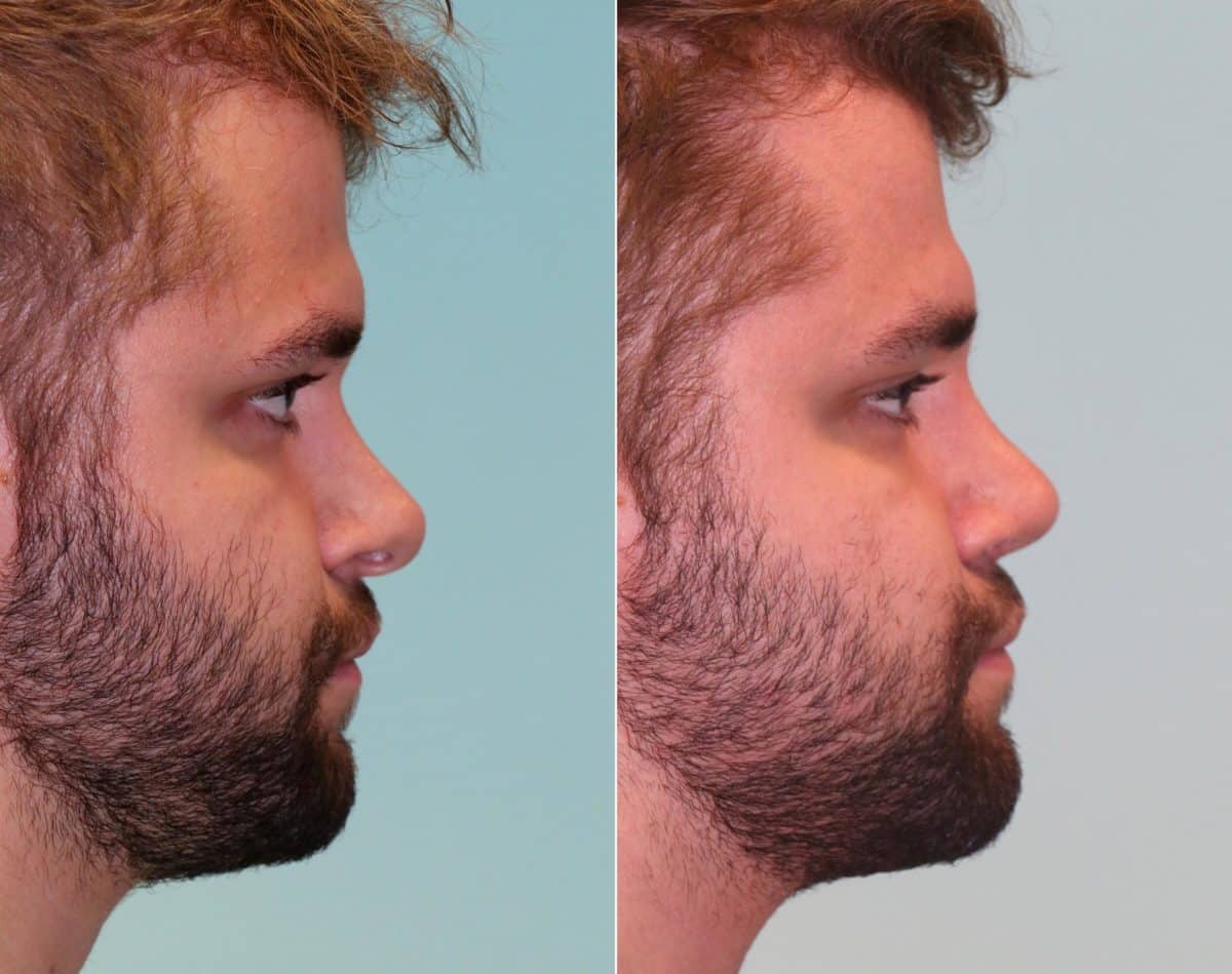 Before and after Revision Rhinoplasty by Dr. Shervin Naderi, Patient 14725