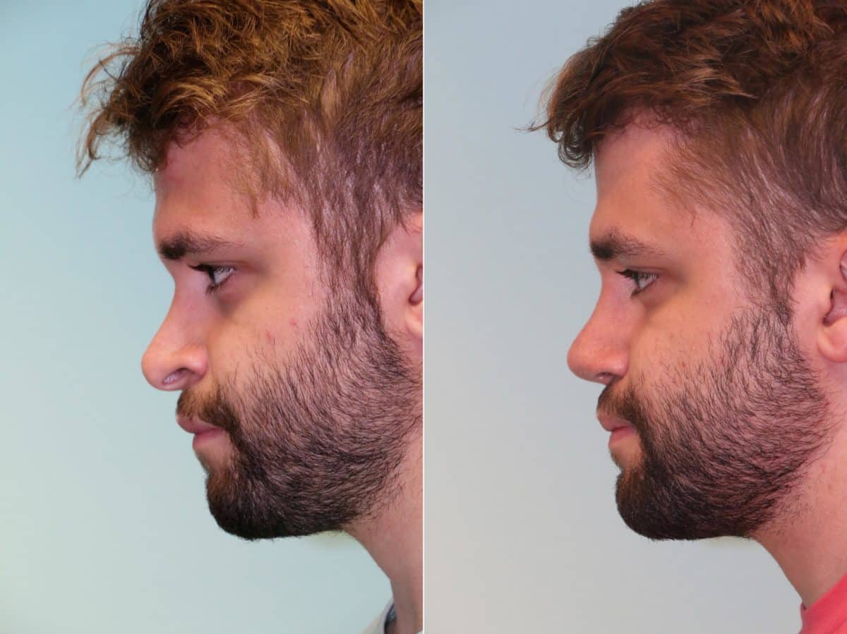 Before and after Revision Rhinoplasty by Dr. Shervin Naderi, Patient 14725