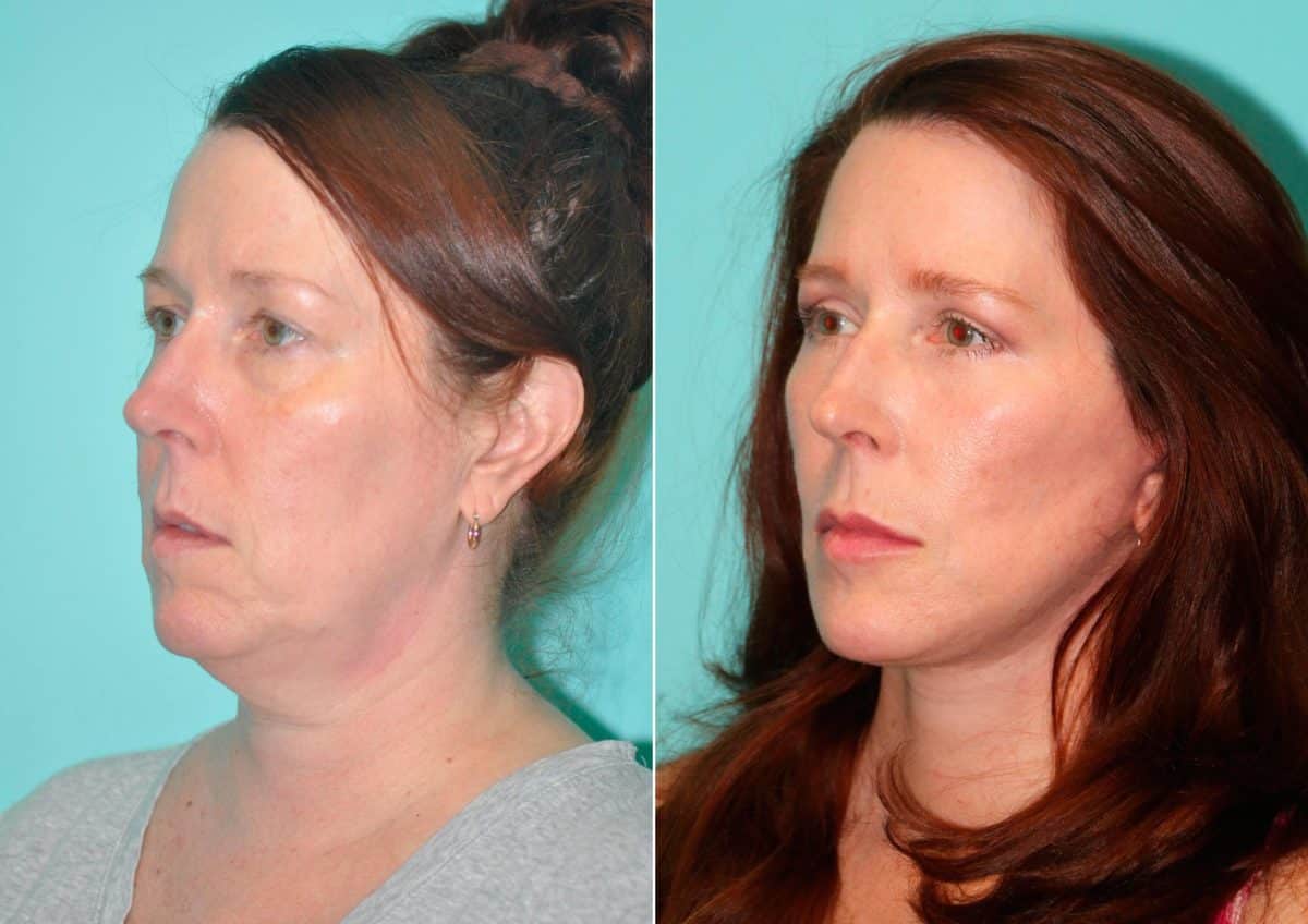 Before and after Facelift by Dr. Shervin Naderi, Patient 14855