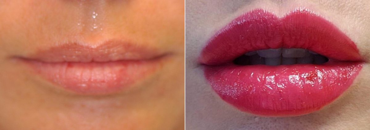 Before and after Lip Augmentation by Dr. Shervin Naderi, Patient 14788