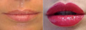 Some patients metabolize the fillers quicker and may need to come in sooner than that and some patients find that they can go one year without a repeat injection.