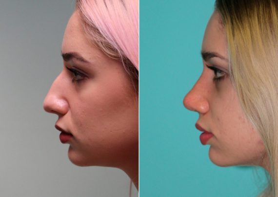 Before and after Rhinoplasty by Dr. Shervin Naderi, Patient 14867