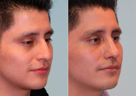 Before and after Rhinoplasty by Dr. Shervin Naderi, Patient 14752