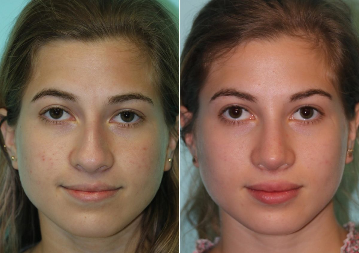 Before and after Rhinoplasty by Dr. Shervin Naderi, Patient 14802