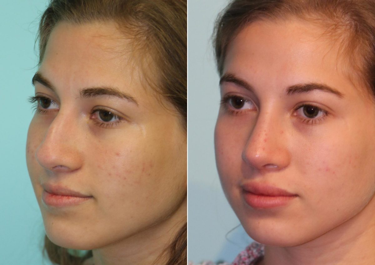 Before and after Rhinoplasty by Dr. Shervin Naderi, Patient 14802