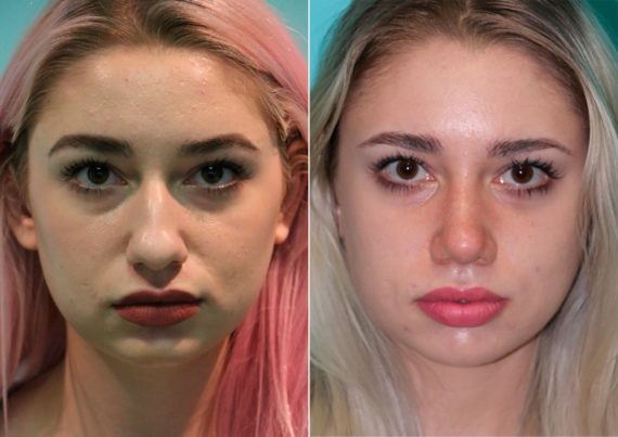 Before and after Rhinoplasty by Dr. Shervin Naderi, Patient 14867