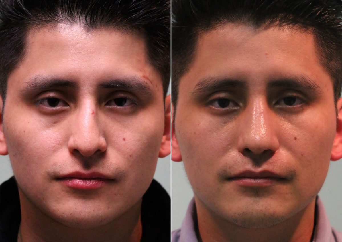 Before and after Rhinoplasty by Dr. Shervin Naderi, Patient 14752