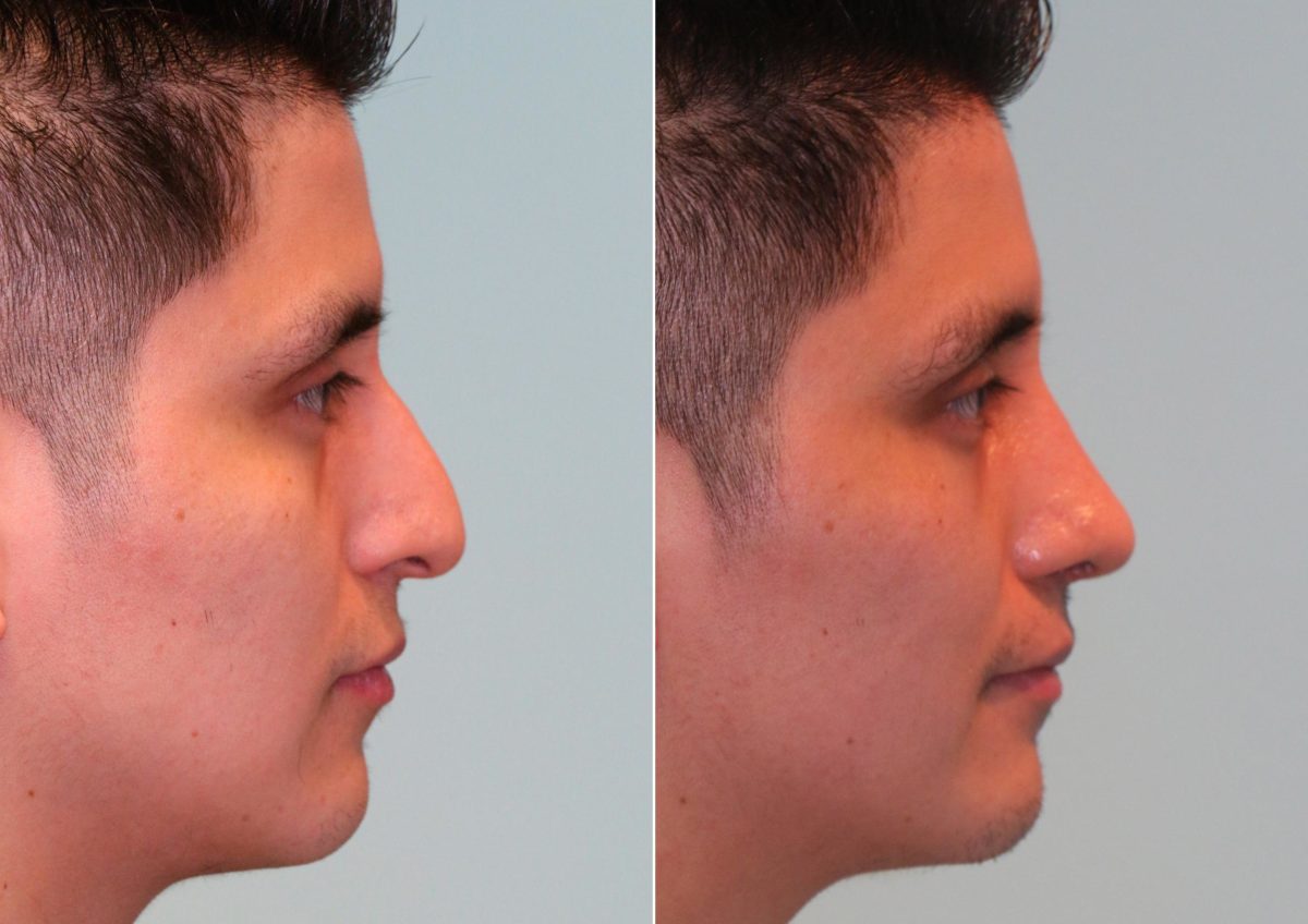 Before and after Rhinoplasty by Dr. Shervin Naderi, Patient 14752