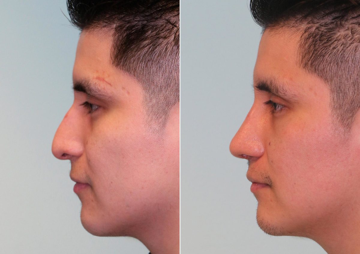 Before and after Rhinoplasty by Dr. Shervin Naderi, Patient 14752