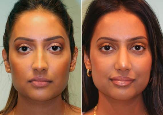 Before and after Rhinoplasty by Dr. Shervin Naderi, Patient 14769