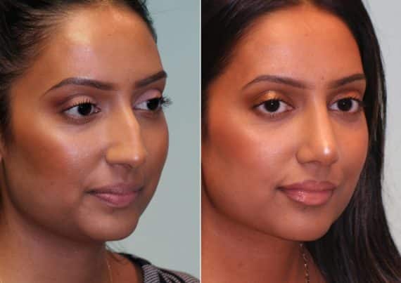 Before and after Rhinoplasty by Dr. Shervin Naderi, Patient 14769