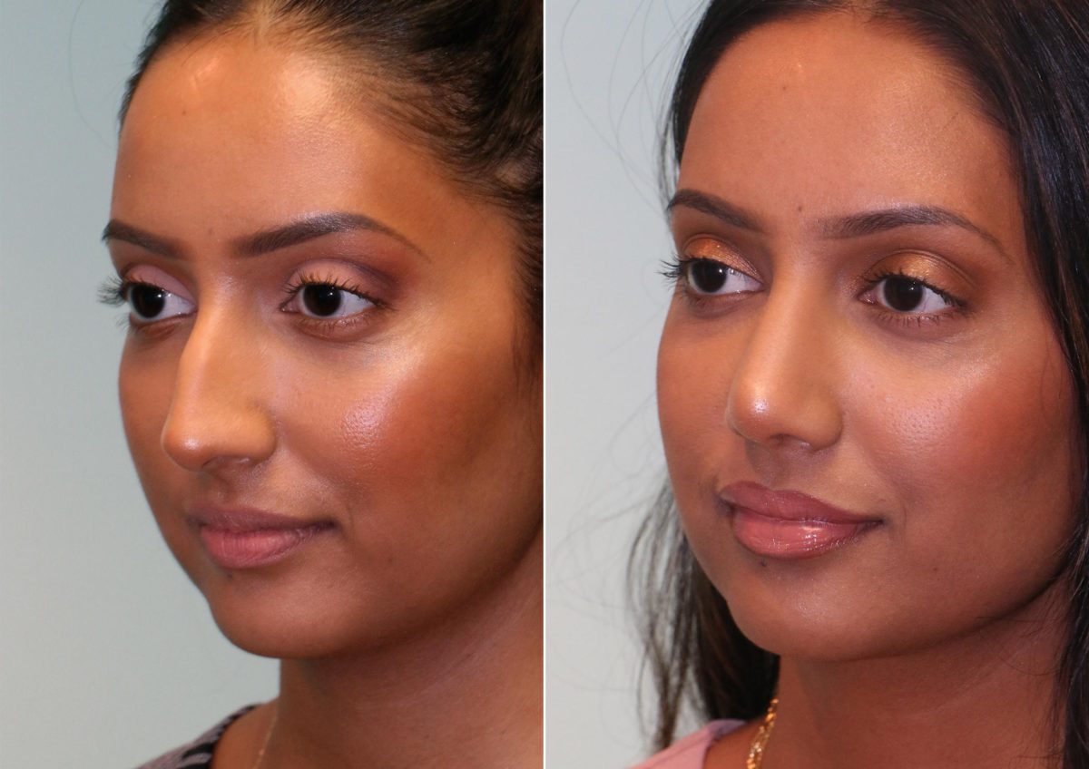 Before and after Rhinoplasty by Dr. Shervin Naderi, Patient 14769