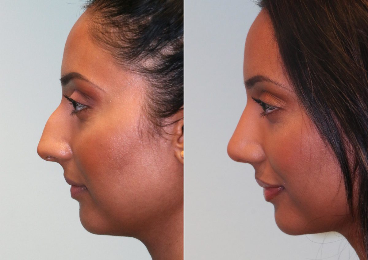 Before and after Rhinoplasty by Dr. Shervin Naderi, Patient 14769