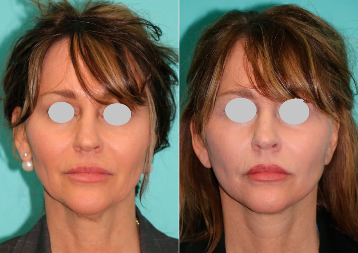 Before and after Facelift by Dr. Shervin Naderi, Patient 15036