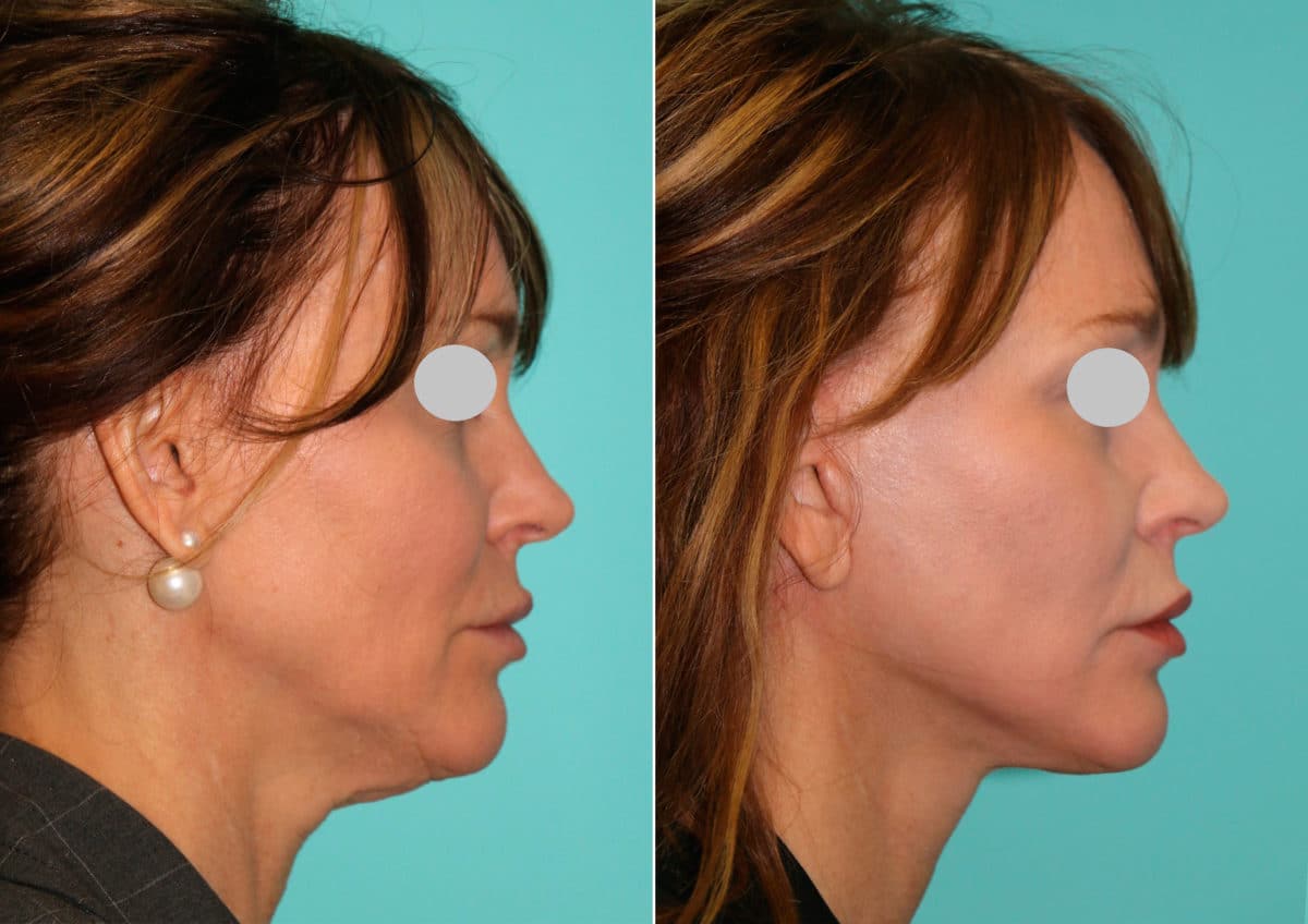 Before and after Facelift by Dr. Shervin Naderi, Patient 15036