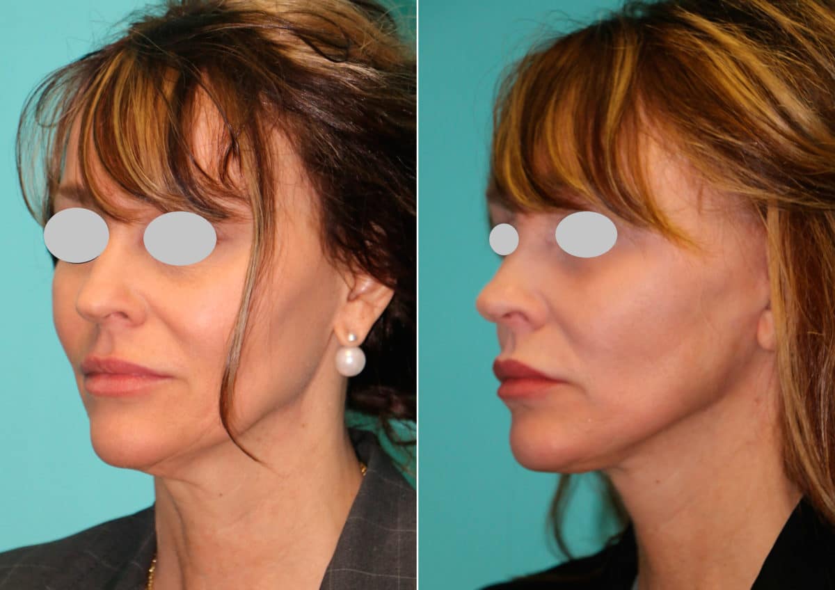 Before and after Facelift by Dr. Shervin Naderi, Patient 15036