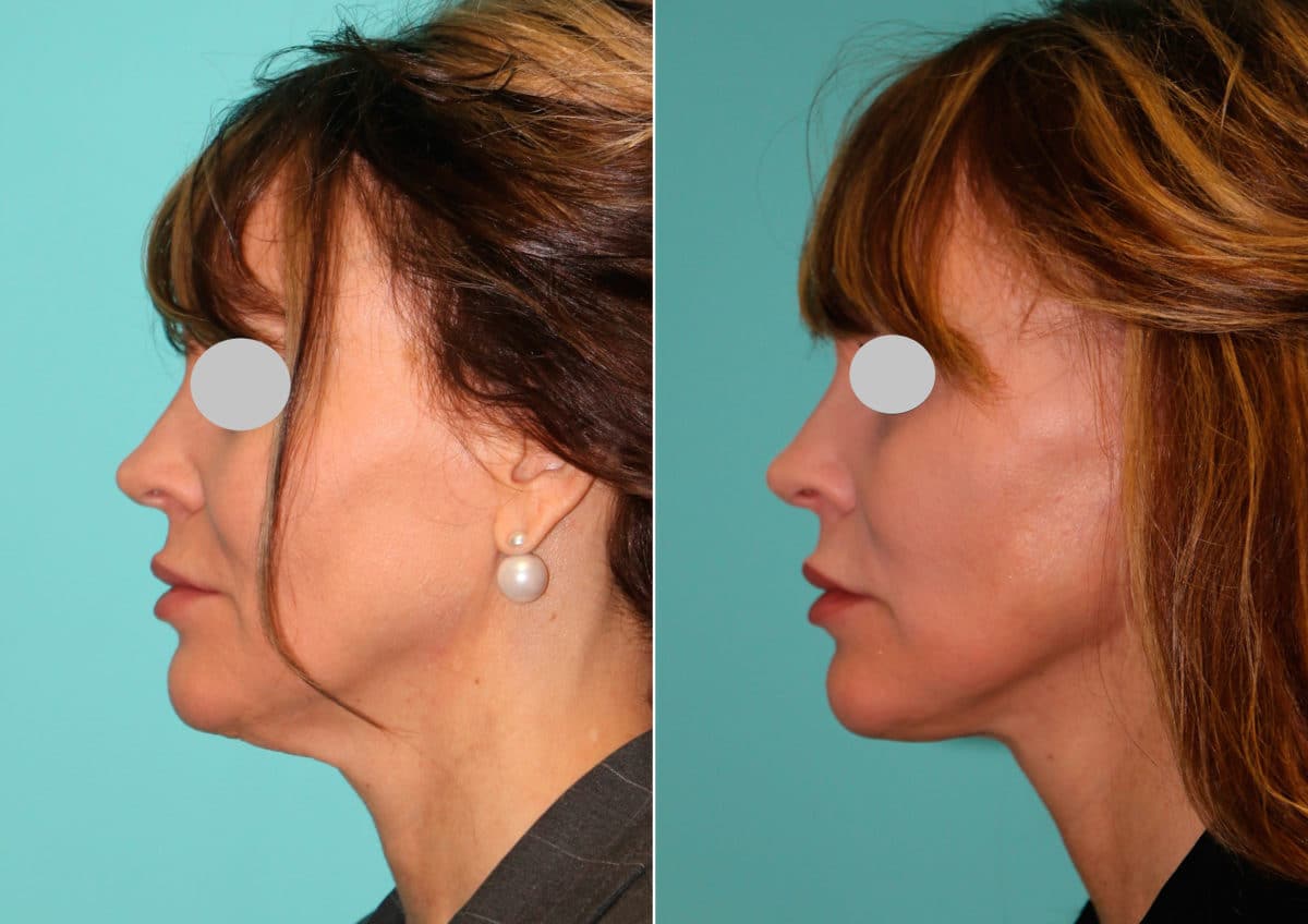 Before and after Facelift by Dr. Shervin Naderi, Patient 15036