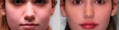 Lip Augmentation before and after at The Naderi Center, Reston, VA and Chevy Chase, MD, Patient 15005