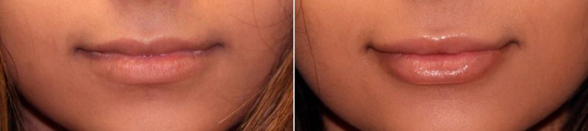 Before and after Lip Augmentation by Dr. Shervin Naderi, Patient 14924