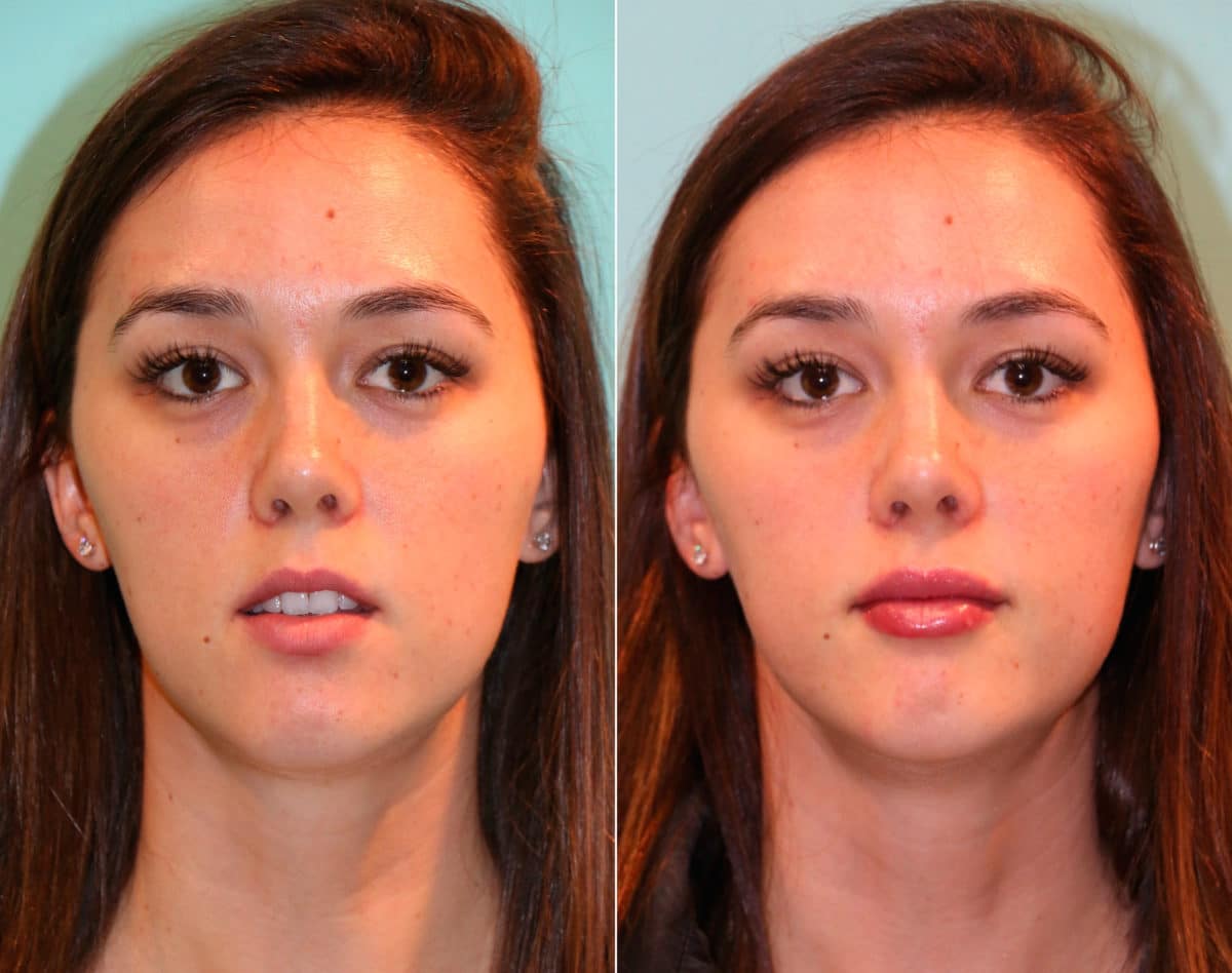 Before and after Lip Augmentation by Dr. Shervin Naderi, Patient 15012